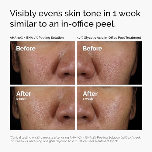 The Ordinary Exfoliate & Hydrate Serum Duo, AHA 30% + BHA 2% Peeling Solution and Hyaluronic Acid 2% + B5, Exfoliating and Hydrating Skincare Set, 1 Fl Oz Each