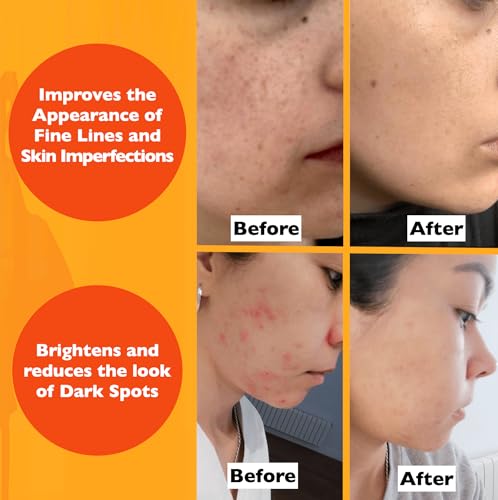 Vitamin C Serum For Face – Anti Aging Face Serum with Vitamin C, Hyaluronic Acid, Vitamin E. Brightening Formula. Improve Appearance of Dark Spots, Tone, Fine Lines & Wrinkles, Glowing Skin 2 Fl Oz