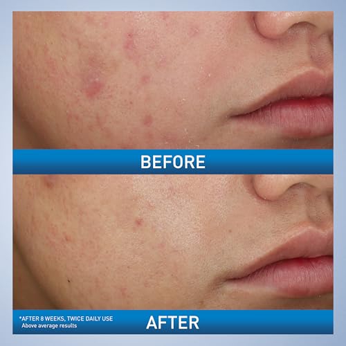 CeraVe Acne Foaming Cream Wash, 10% Benzoyl Peroxide Facial Cleanser, 5oz