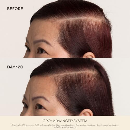 VEGAMOUR Scalp Dermaroller - MD-Developed, 1,200 Medical-Grade Needles, Enhances Serum Absorption, Twist-On Replaceable Head, Protective Case Included
