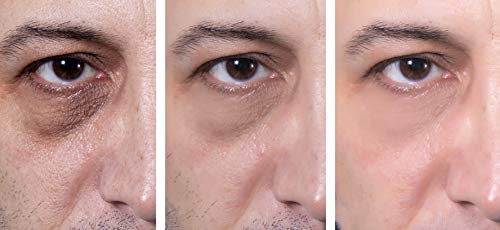 Eye Gel, for Dark Circles, Puffiness, Wrinkles, Skin Firming and Bags - Effective Anti-Aging Eye Gel for Under and Around Eyes including Crows Feet with Hyaluronic Acid and Aloe Vera- 1.7 fl. oz.