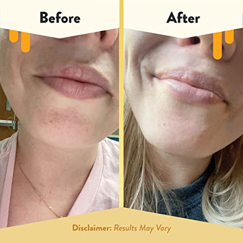 ECZEMA HONEY Nourishing Lip Balm, Daily Lip Moisturizer for Dry Lips (1 Ct)