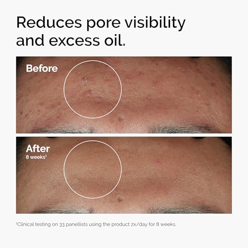 The Ordinary Serum Favorites Set – Hyaluronic Acid 2% + B5, Niacinamide 10% + Zinc 1%, Caffeine Solution 5% + EGCG Eye Serum, Serums for Hydrating, Brightening & Pore-Minimizing Skin Care