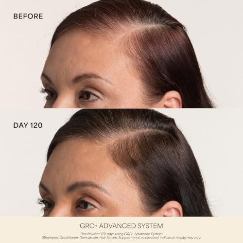 VEGAMOUR Scalp Dermaroller Replacement Head, MD-Developed - 1,200 Medical-Grade Needles, Easy Twist-On Fit