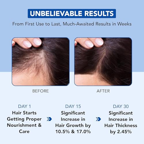 Botanic Hearth Rosemary Oil for Hair Growth - 6.7 Fl oz