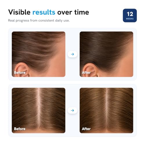 Be Bodywise Hair Growth Serum Roll On - 5% Saw Palmetto, 3% Rosemary Oil for Hair Growth, 3% Fenugreek,1% Caffeine Herbasome | Serum for Hair Loss & Hair Regrowth For Men & Women 25ml/0.84 fl oz