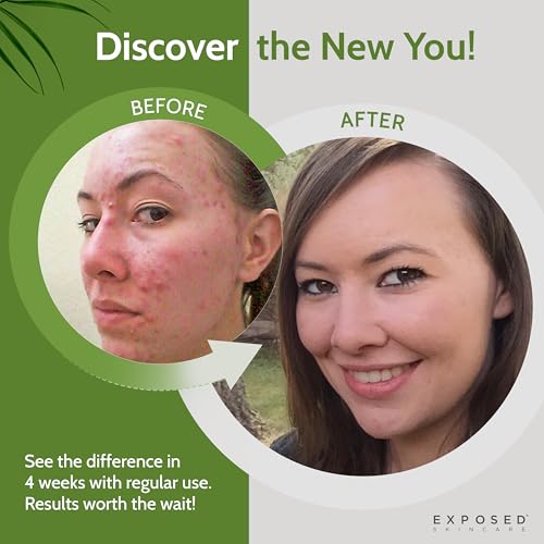 Exposed Skin Care Acne Facial Cleanser with 0.5% Salicylic Acid