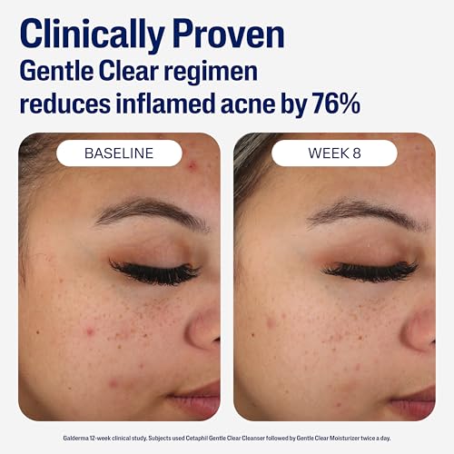 Cetaphil Gentle Clear Mattifying Acne Face Moisturizer, Salicylic Acid, 3oz