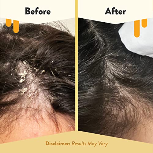 ECZEMA HONEY Soothing Scalp Oil, Daily Itchy Scalp Relief Serum (1 Oz)
