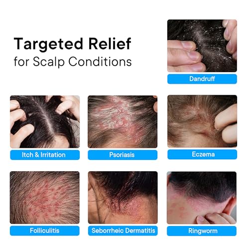 ProBliva Psoriasis Scalp Spray – Scalp Treatment for Psoriasis, Dandruff & Seborrheic Dermatitis – On-Demand Itch Relief – Helps Reduce Flaking & Dryness – Lightweight & Non-Greasy (4 fl oz)