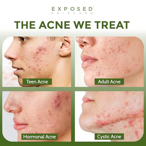 Exposed Skin Care Acne Facial Cleanser with 0.5% Salicylic Acid