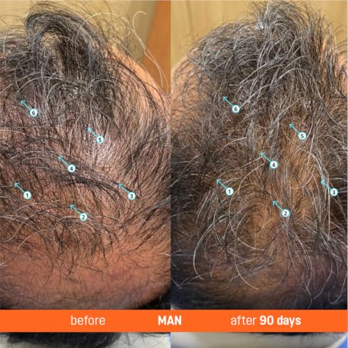 Abera Hair Serum with Redensyl 2%, Plant-Based Peptide Formula for Thinning, Fine, or Shedding Hair, Lab-Tested Botanical Actives, For Women & Men, 1.69 fl oz