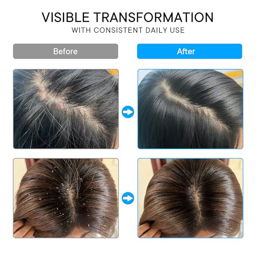 ProBliva Psoriasis Scalp Spray – Scalp Treatment for Psoriasis, Dandruff & Seborrheic Dermatitis – On-Demand Itch Relief – Helps Reduce Flaking & Dryness – Lightweight & Non-Greasy (4 fl oz)