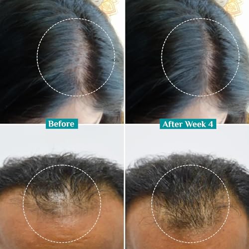 Pilgrim Advanced Hair Growth Serum with Redensyl 3%, Anagain 4% & Baicapil | Hair Fall Control & Regrowth | Korean Black Rice | For Men & Women, 1.01 Fl Oz (30ml)
