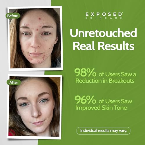 Exposed Skin Care Acne Facial Cleanser with 0.5% Salicylic Acid