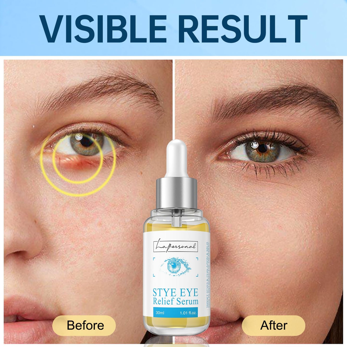 LA.PERSONAL Stye Eye Treatment, Chalazion Remover, Eye Serum for Styes Chalazion and Blepharitis Treatment, with Avocado oil, Sea buckthorn oil & Caffeine 1.01 Fl oz/30 Ml