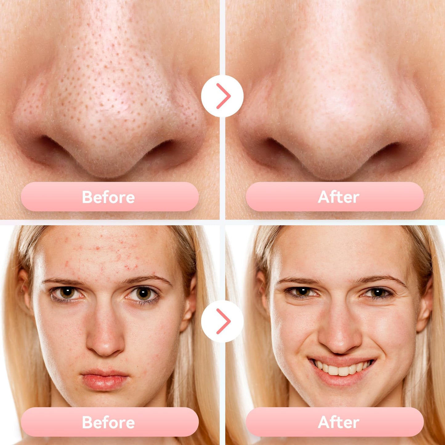 Newest Blackhead Remover Pore Vacuum Upgraded Facial Pore Cleaner Electric Comedone Whitehead Extractor Tool-5 Suction Power,5 Probes,USB Rechargeable Blackhead Vacuum Kit for Women & Men